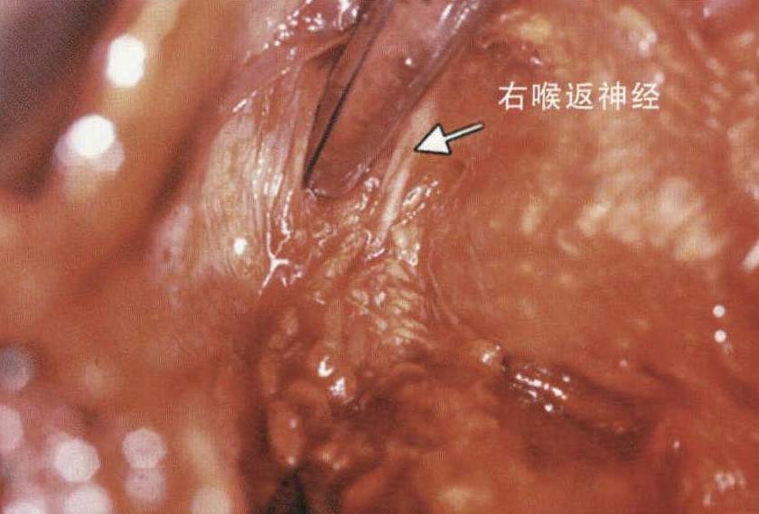 三野淋巴結(jié)清掃的食管切除術(shù)